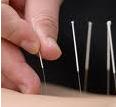 Acupuncture, Scalp Acupuncture